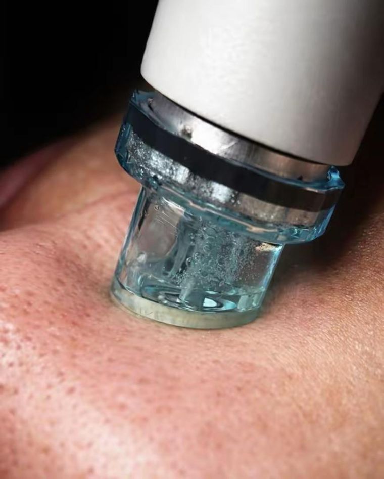 HydraFacial deep cleansing